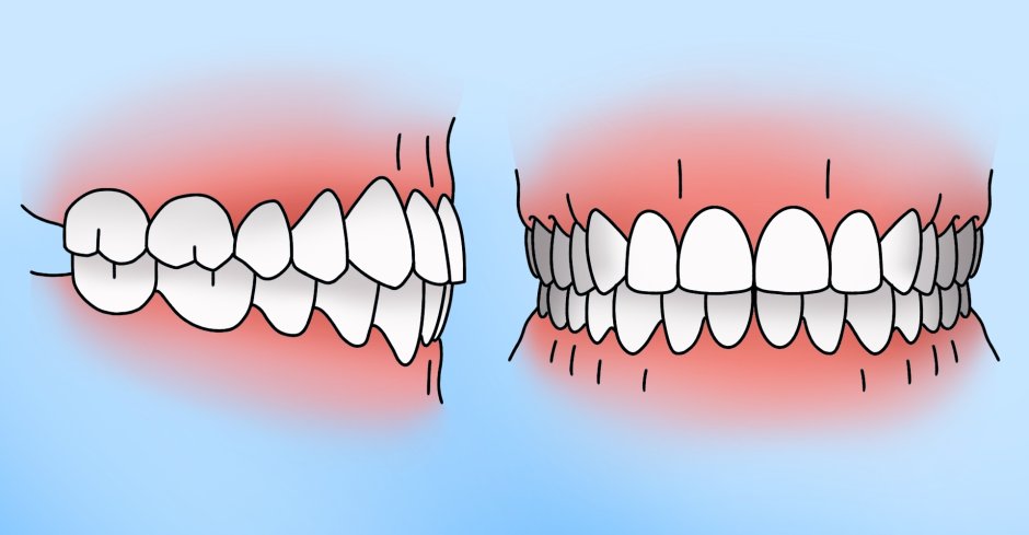 Первый премоляр нижней челюсти