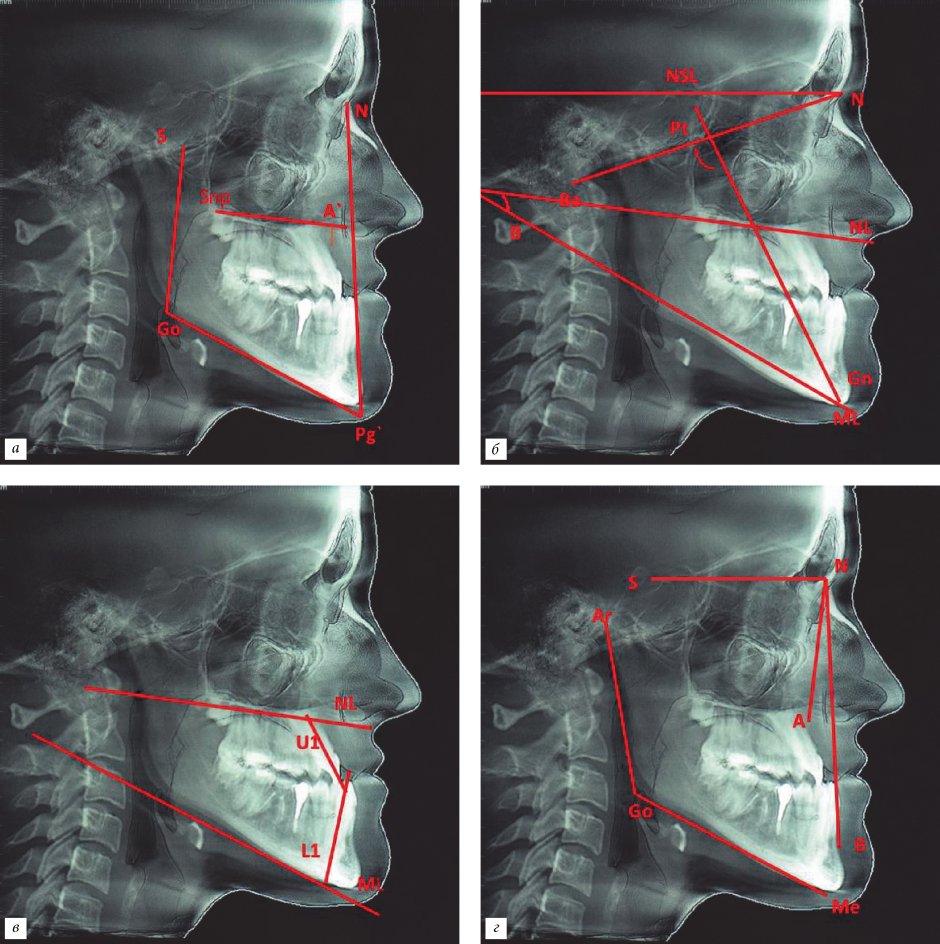 Аппарат Брюкля при мезиальном прикусе