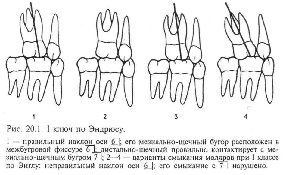 Дистальный прикус и осанка