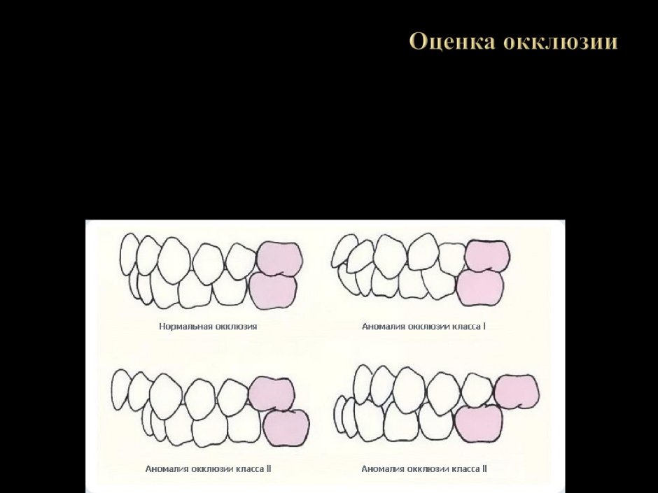 Рисунок ортодонтического аппарата на модели