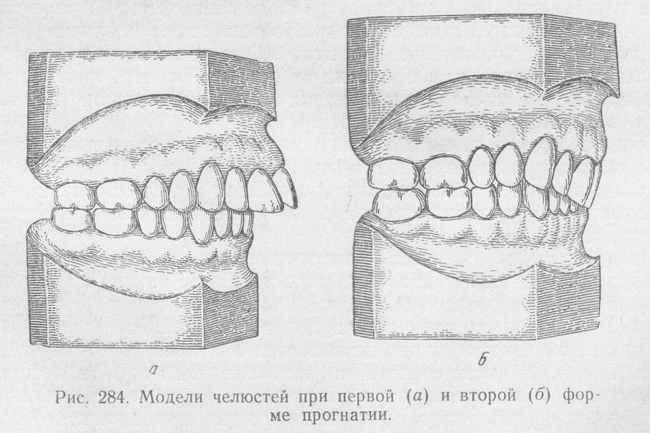 Классификация аномалий окклюзии Энгля