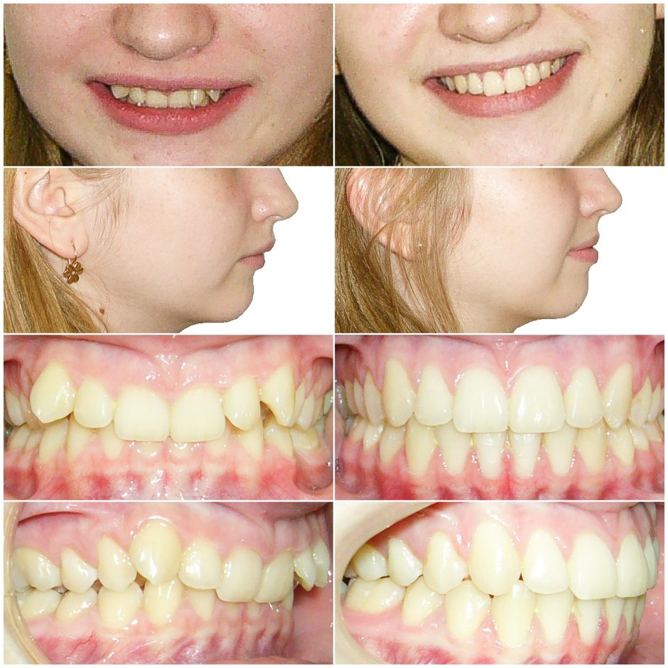 Дистальный прикус нижняя челюсть