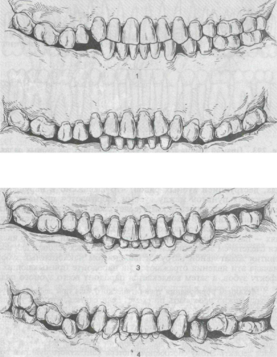Tandem мезиальная окклюзия