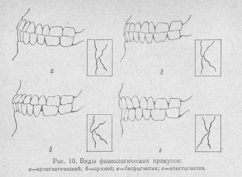 Форсус аппарат для дистального прикуса
