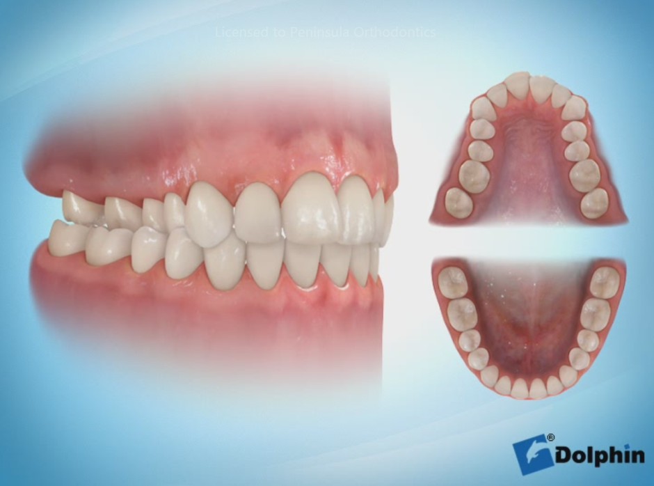 Выпирающая нижняя челюсть