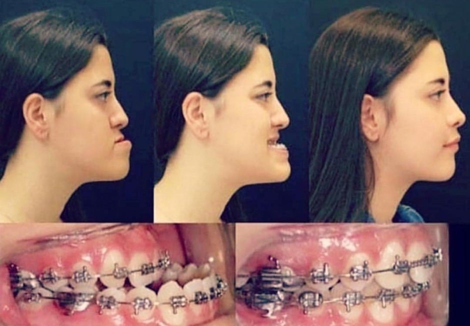 Прикус нижней челюсти впереди