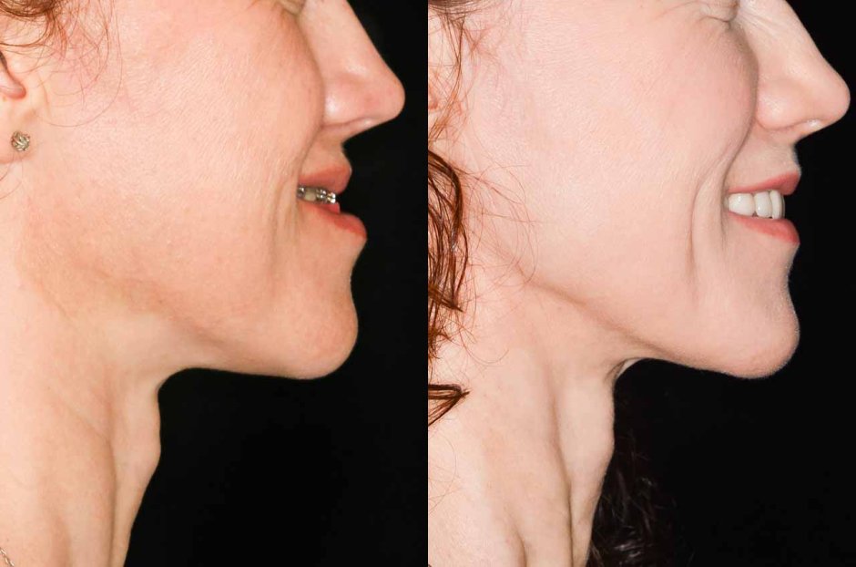 Мезиальный прикус профиль