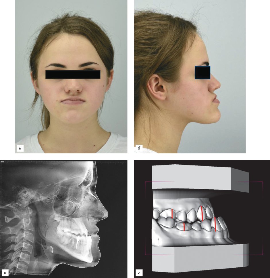 Глубокий дистальный прикус профиль
