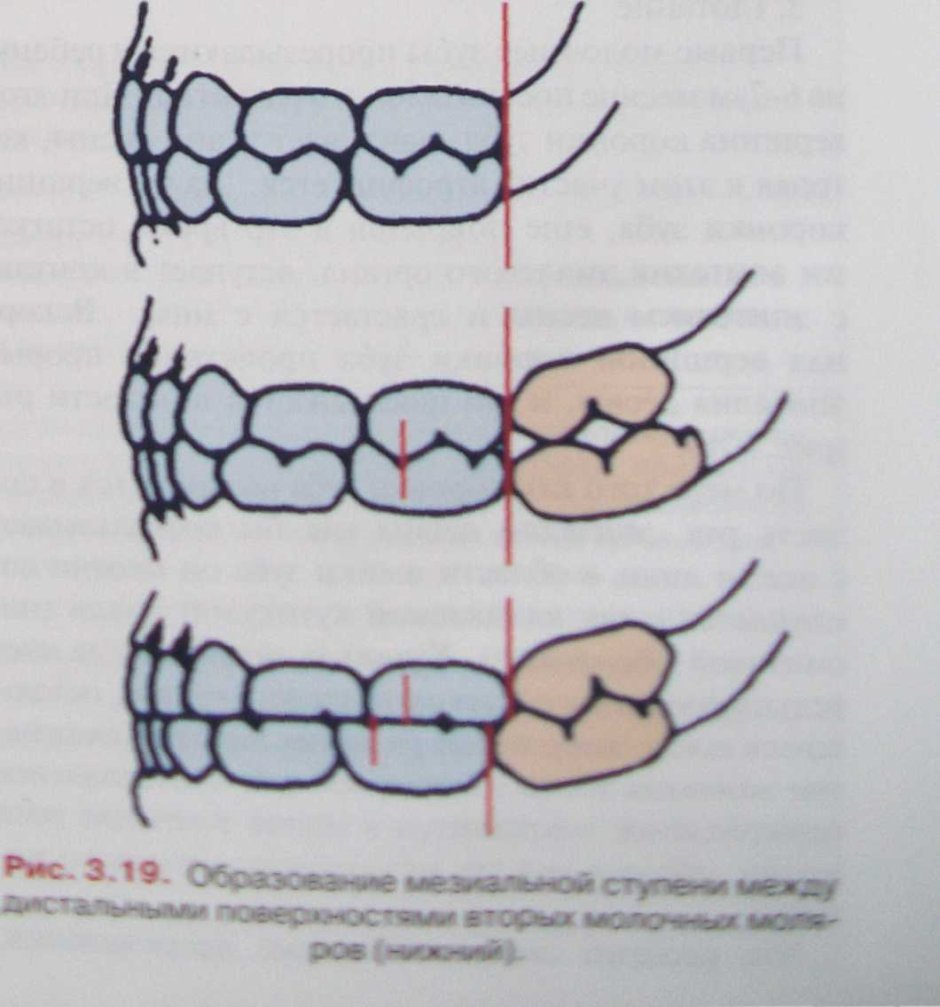 Мезиальная ступень в Молочном прикусе