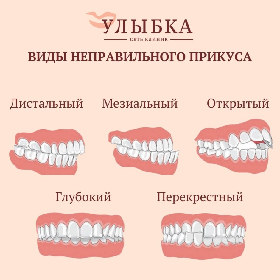 Правильный прикус у человека схема сбоку