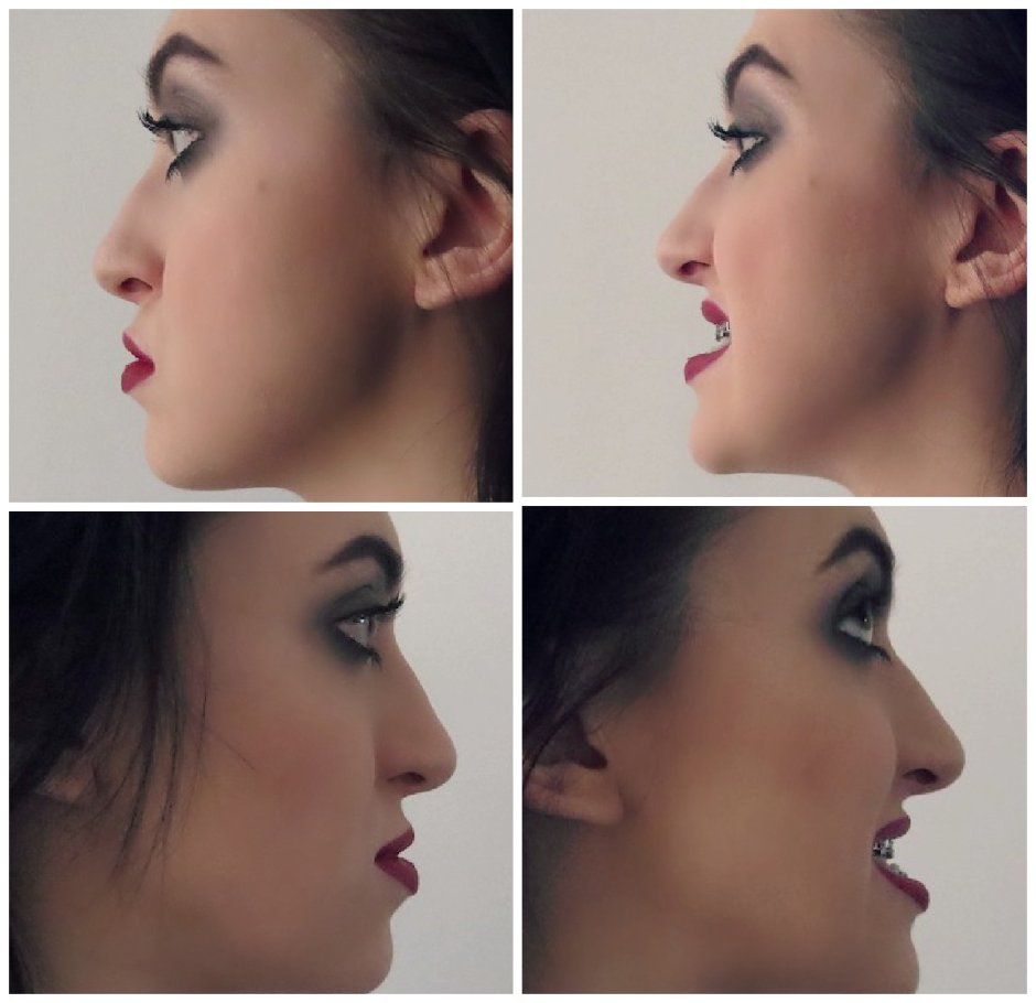 Виниры элайнеры