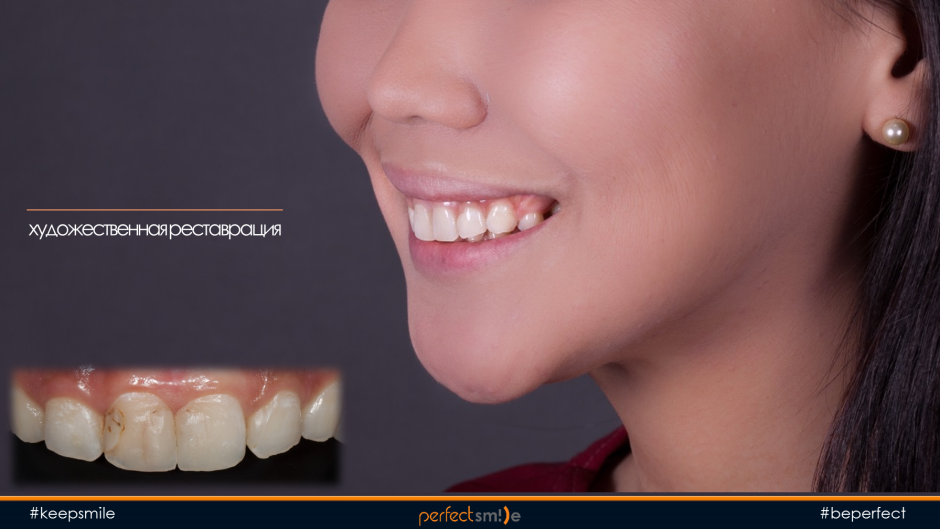 Мезиальный перекрестный прикус